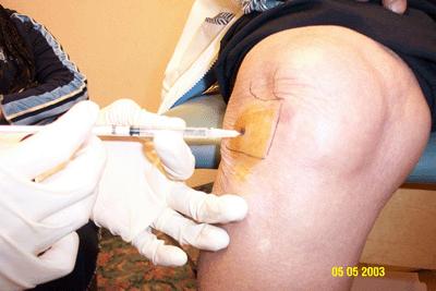 Side effects of steroids for arthritis