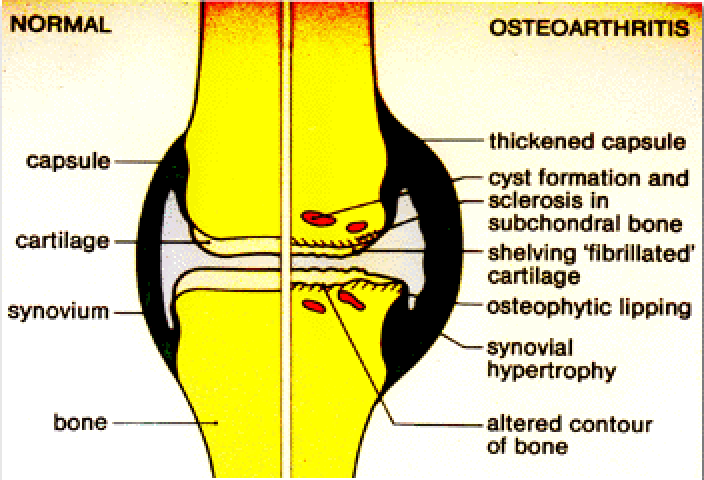 Osteoarthritis