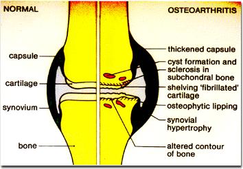 Reumatism: Ce este, Care sunt Simptomele & Tratament